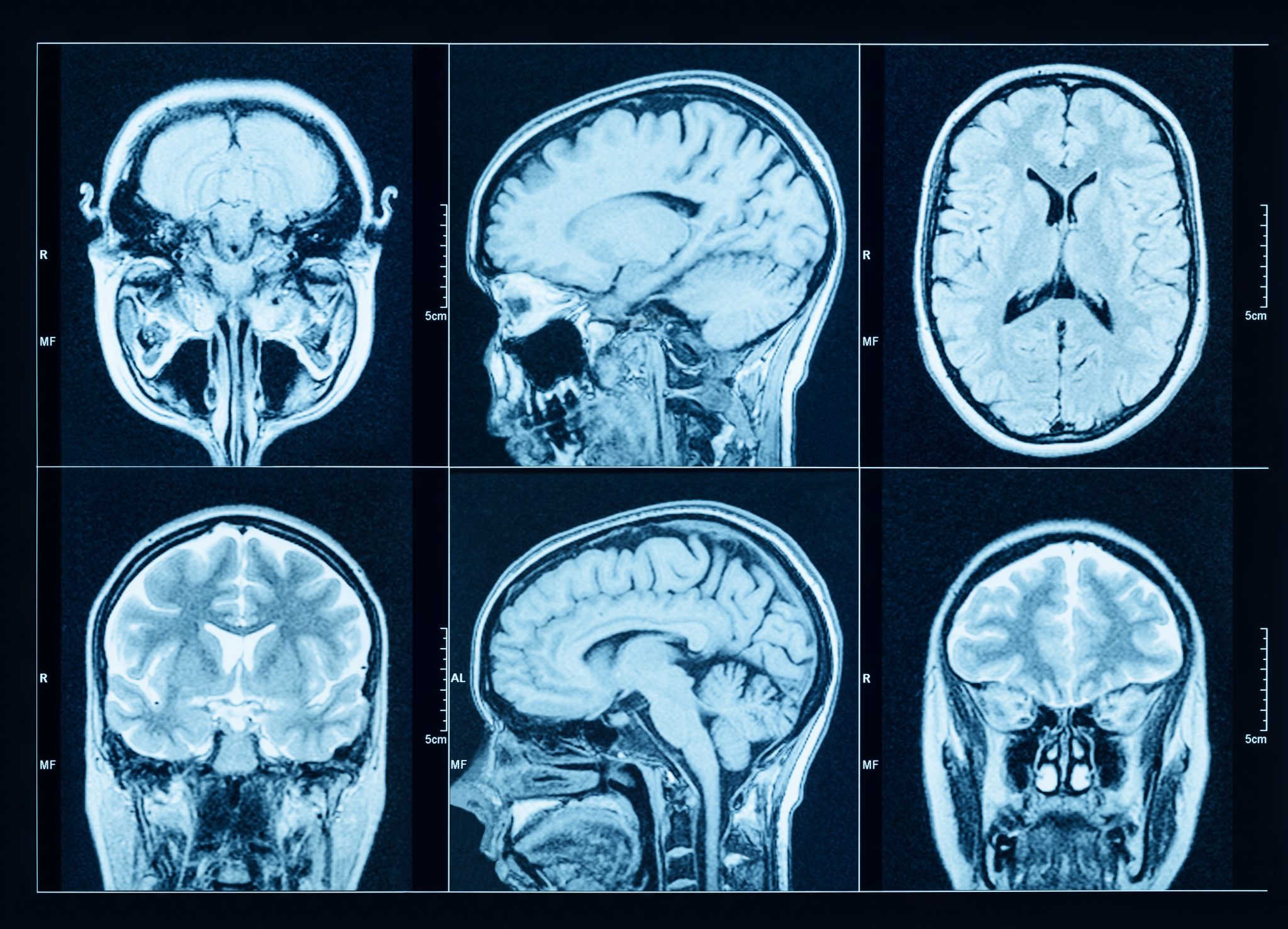 Resonancia magnética cerebral usada en el estudio clínico de conductas adictivas