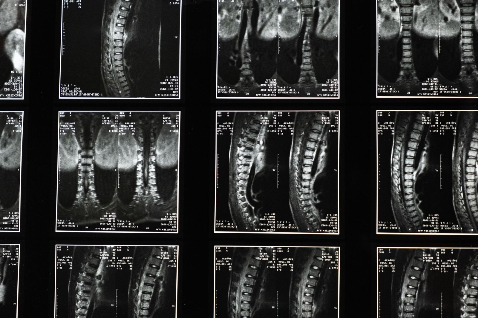 Resonancia magnética de columna cervical en pantalla de equipo hospitalario
